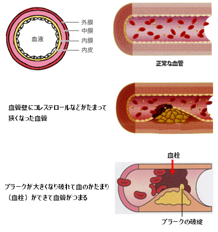 arteriosclerosis_01.jpg