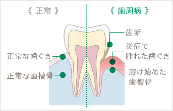 咬合性外傷