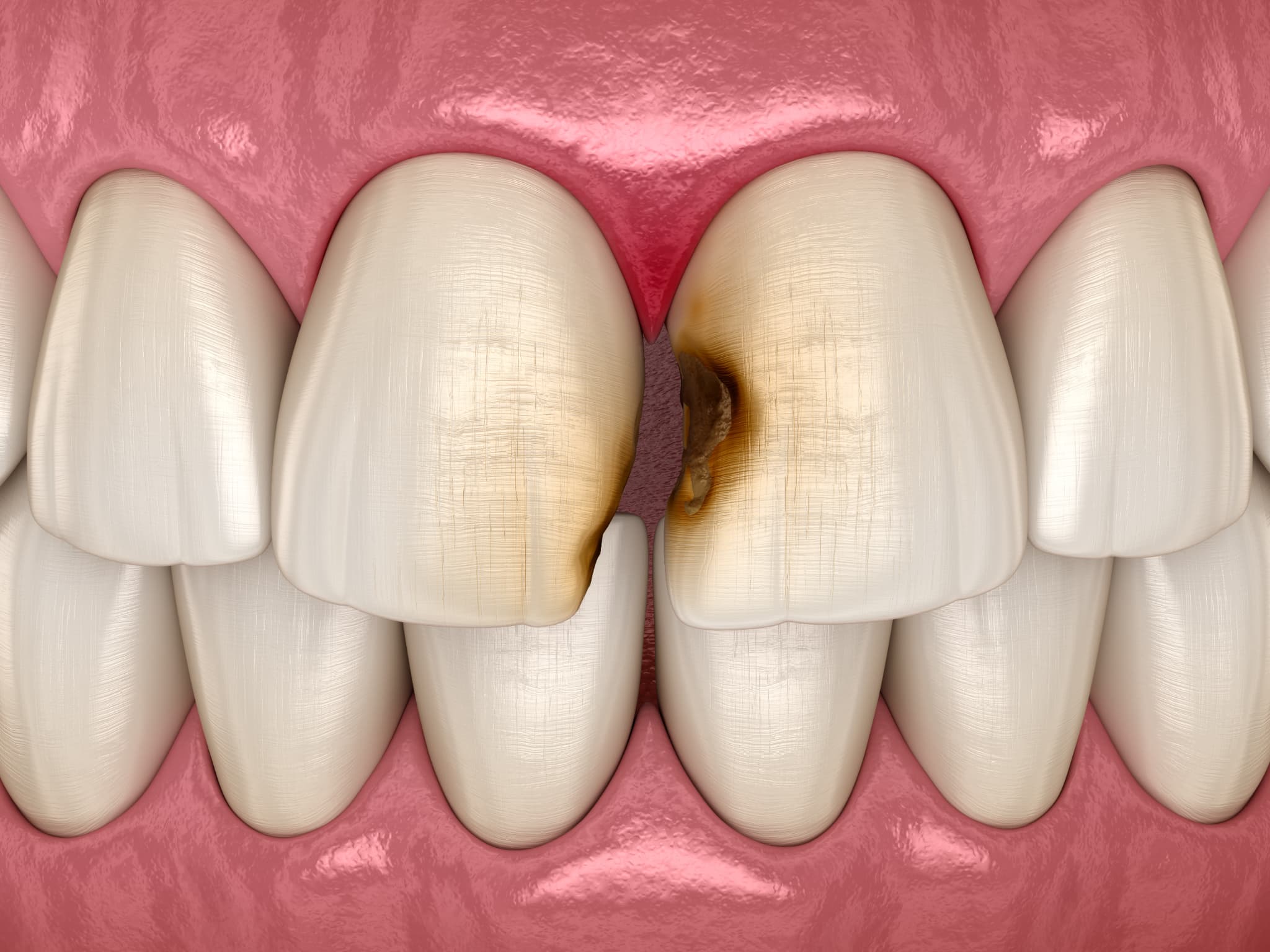 虫歯になった前歯