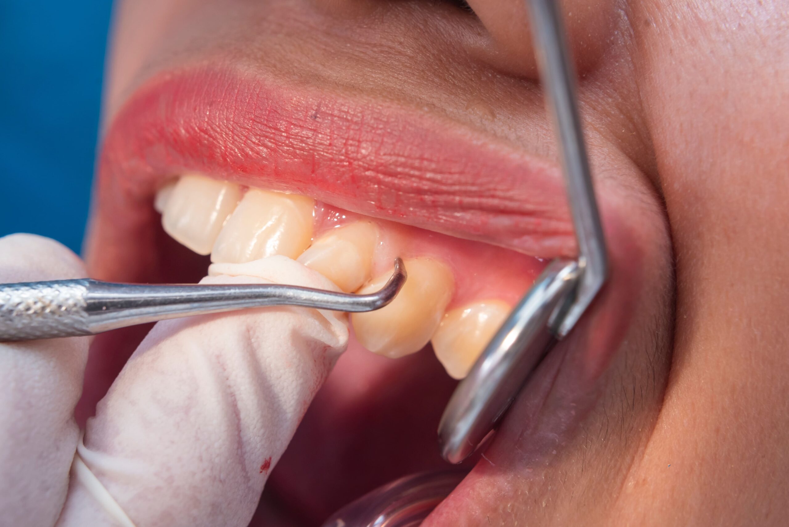 歯科医師が口臭の原因となる歯石除去の基本治療であるスケーリングを行っている