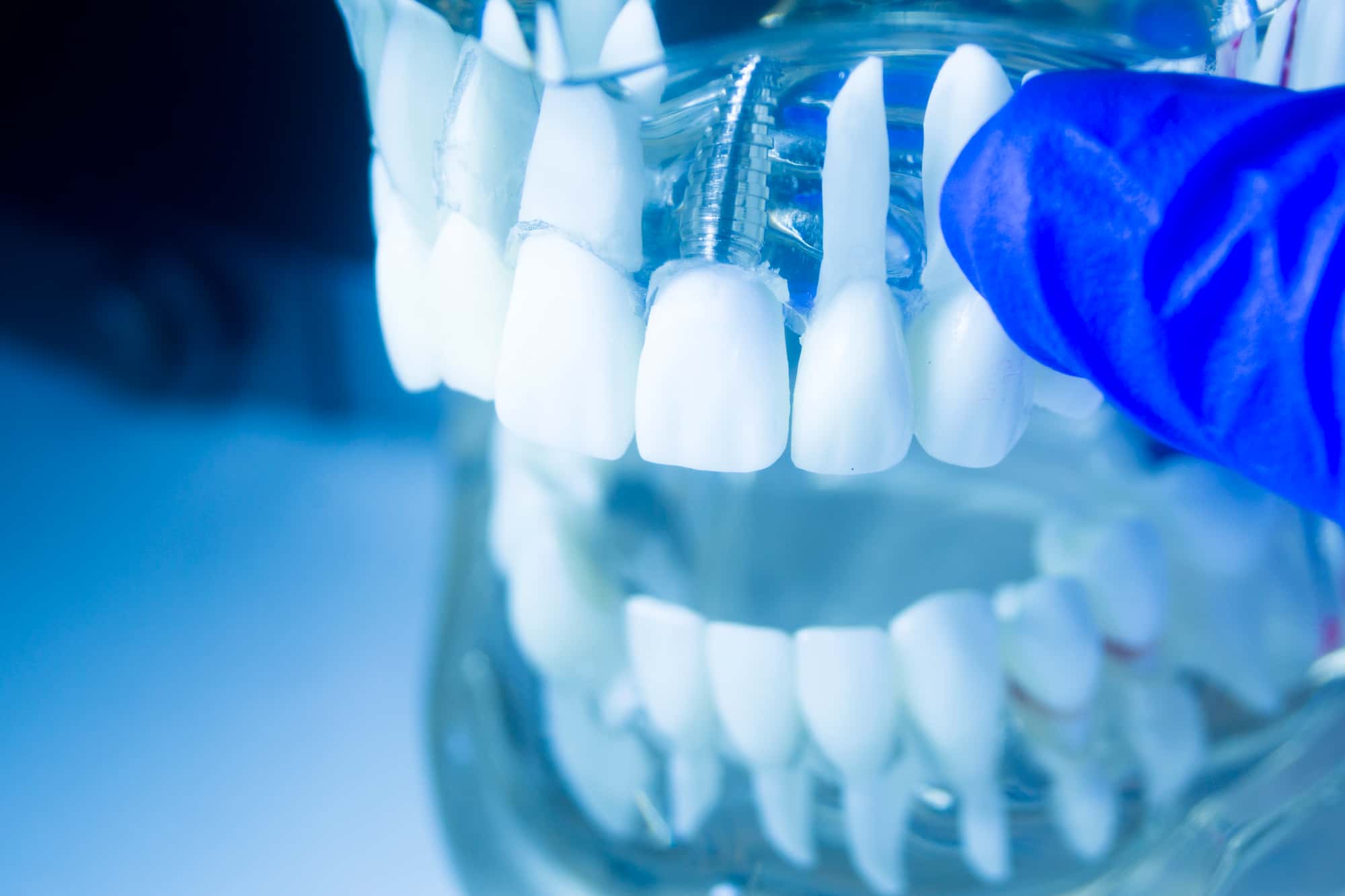 インプラントの前歯のイメージ