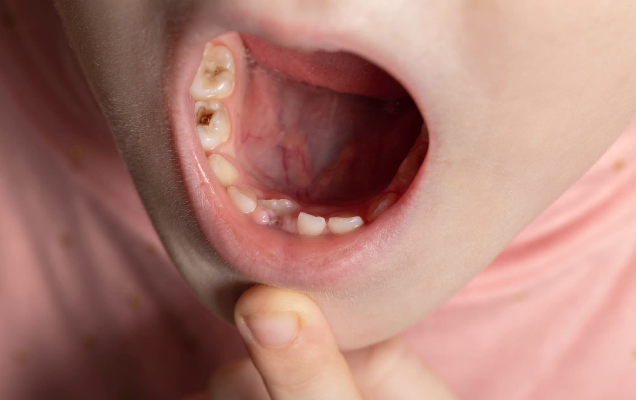 奥歯が虫歯になっている子どもの口腔内