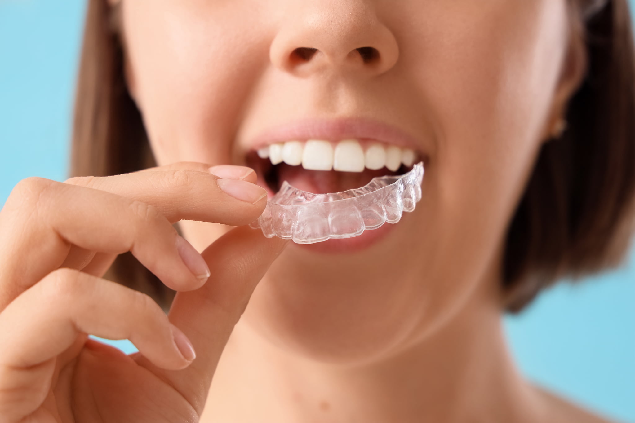 歯ぎしり対策でナイトガードを装着するイメージ
