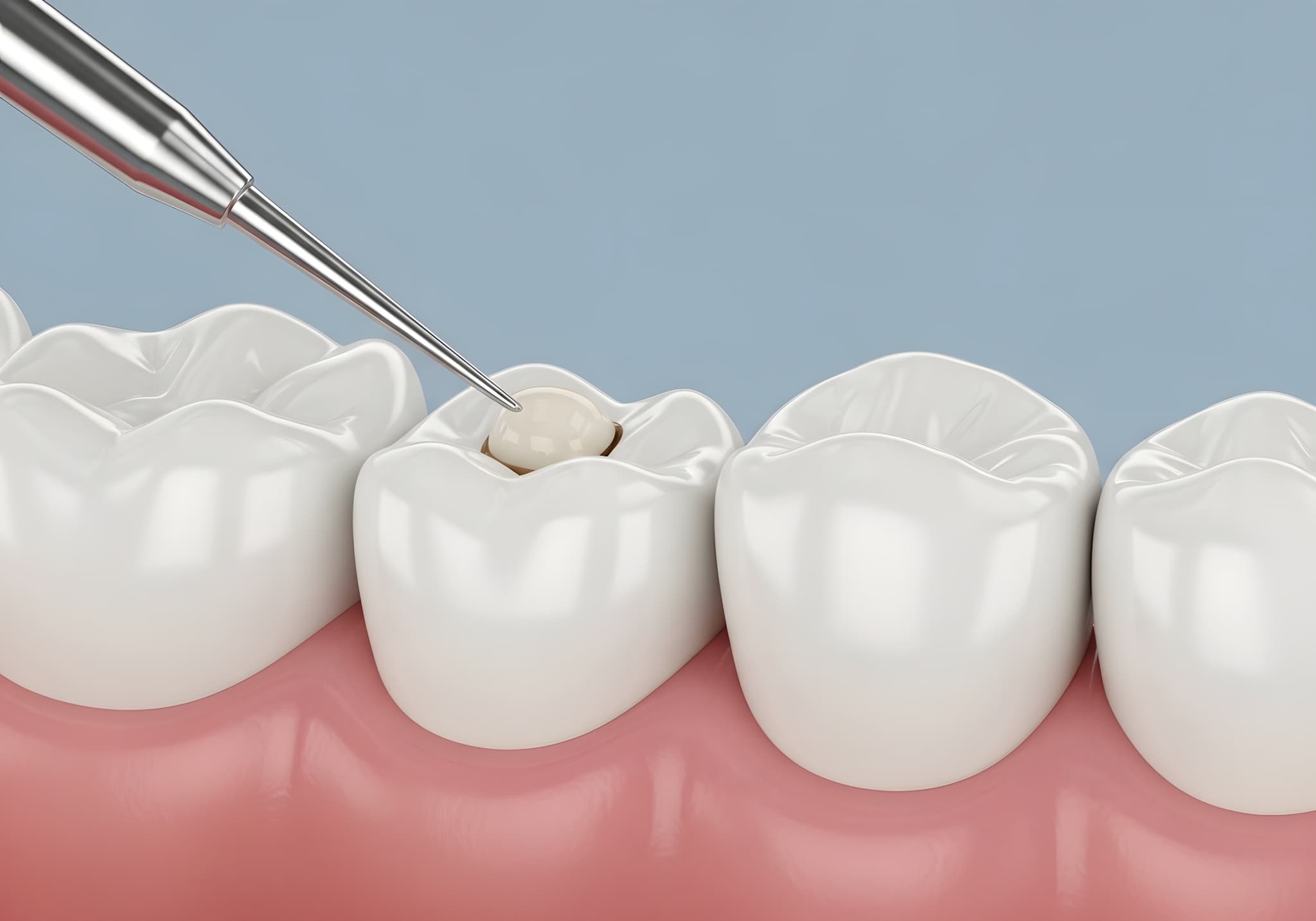 コンポジットレジンで銀歯を白くする様子
