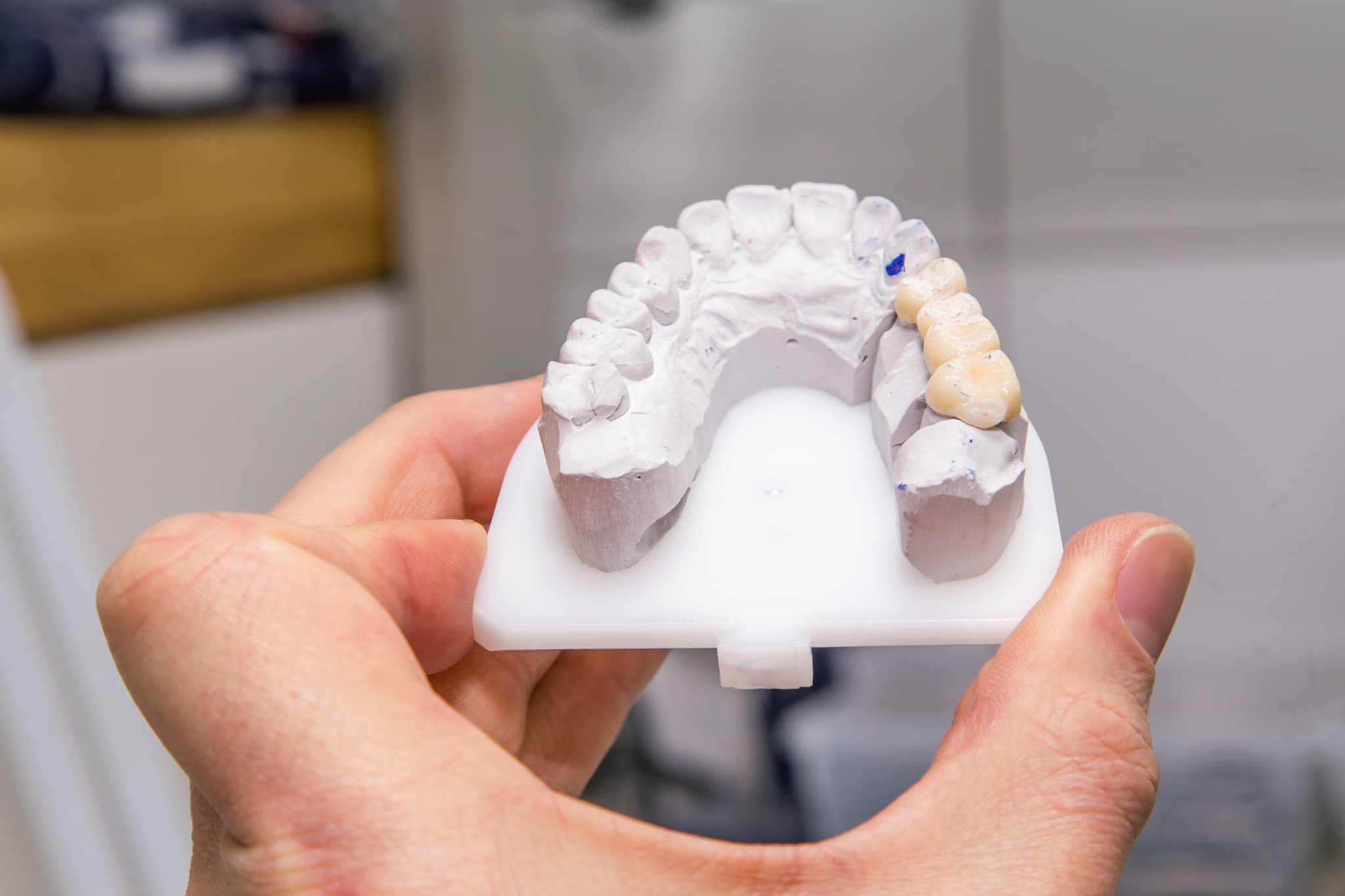 歯のブリッジのイメージ